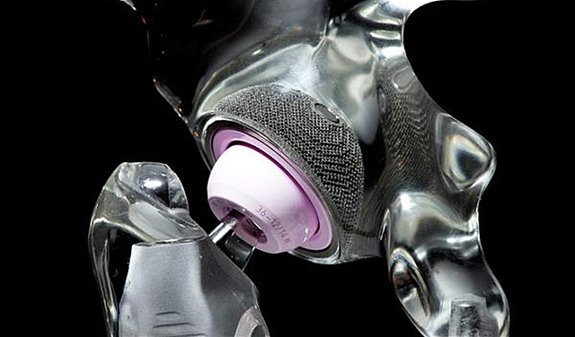 los reemplazos articulares en la actualidad