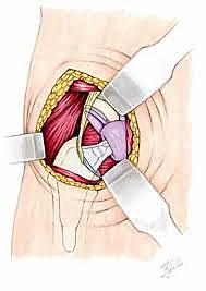 los abordajes actuales son