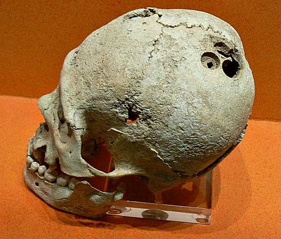 Se había practicado trepanaciones.