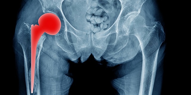 "ARTROPLASTIA DE INTERPOSICIÓN" Loewe