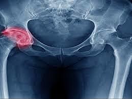 "ARTROPLASTIA DE INTERPOSICIÓN"  Robert jones