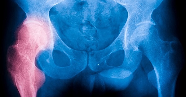 "ARTROPLASTIA DE INTERPOSICIÓN"  Baer