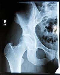 "ARTROPLASTIA DE INTERPOSICIÓN"  Verneuil