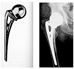 Artroplastia, con diseño endoprotesis . Moore