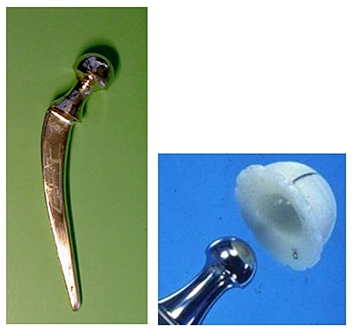 Cambios en la protesis de Charnley