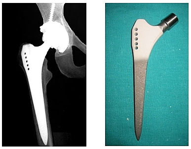 Actualidad de la artroplastia