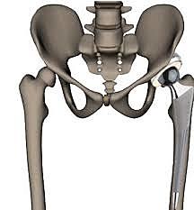 Primer reemplazo de cadera