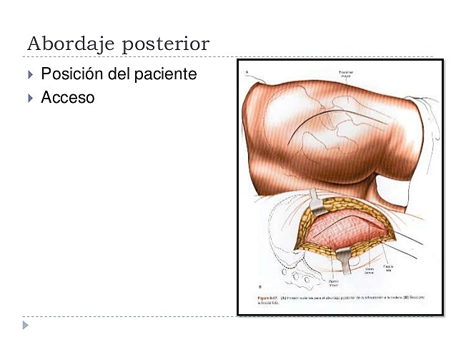 Abordaje actual Posterior o de moore