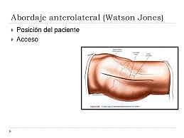Abordaje actual externo o de watson jones