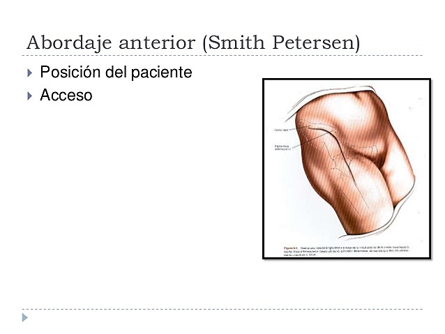 Abordaje actual anterior o de Smith-peterson