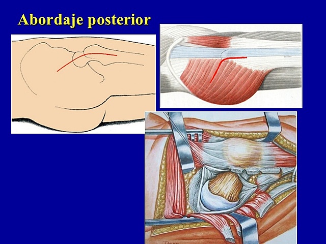 Abordaje actual postero-lateral o de gibson