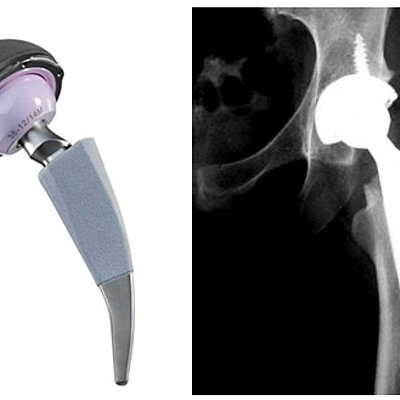 Timeline: Reemplazo de cadera y abordajes