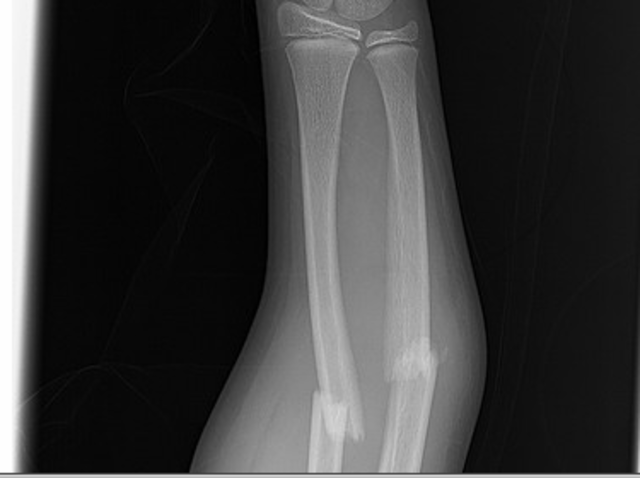 Broke Arm