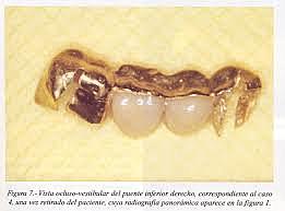Elaboración de un pontico de alambre de plata