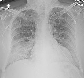 Síndrome respiratorio de Oriente Medio