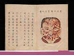 Epidemia De Viruela Japonesa