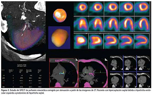 MÉTODOS DIAGNÓSTICOS NUEVOS: SPECT Y PET.