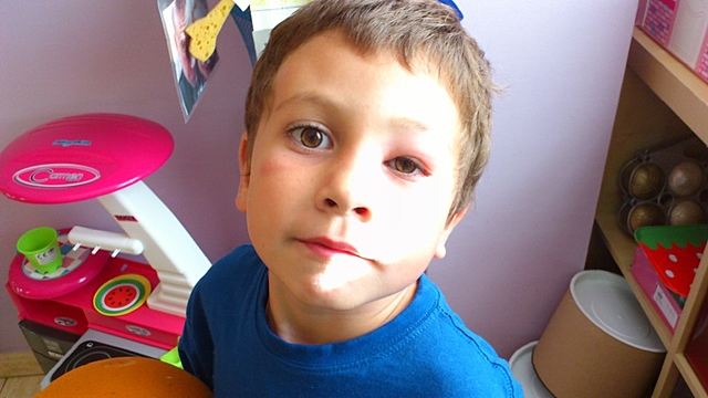 a mosquito bit me in the eye