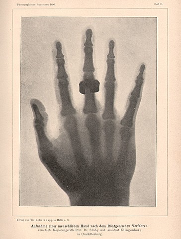 First X-ray - Wilhelm Röntgen