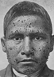 Enfermedad de Carrión