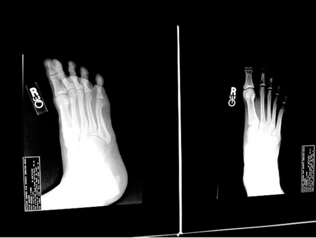 Broken Foot :(