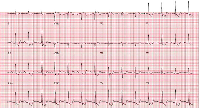 "Now I am having Chest Pain!"