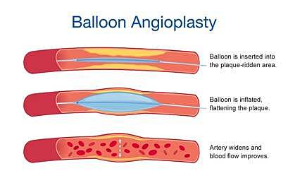 Angioplasty -  the purpose of this treatment  removes cholesterol in the artery system, Improves the blood flow towards heart, Enlarge artery and vein size.