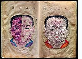 Epidemia de viruela japonesa