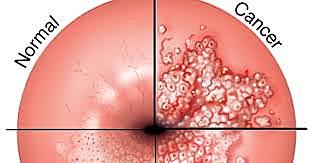 Vacuna contra el Cáncer Cérvico