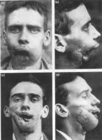 Harold Gillies pioneers the use of 'plastic' surgery