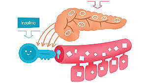 Descubrimiento de diabetes pancreatica