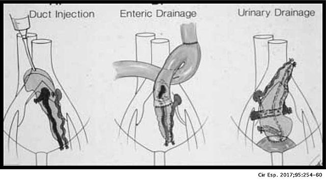Primer transplante pancreatico