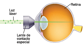 Tratamiento laser para ceguera diabetica