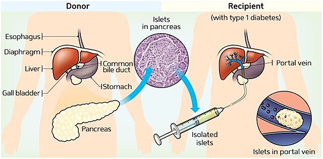 Implante de Islotes de Células Madre