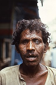 Último caso de viruela adquirida naturalmente