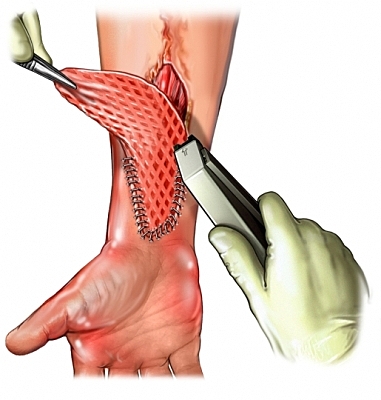 Transplante de tejido