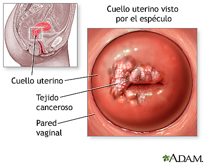 Causa de Cáncer Cervical