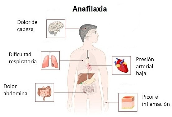 Respuesta anafiláctica