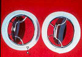 Disco lenticular simple tipo oscilante