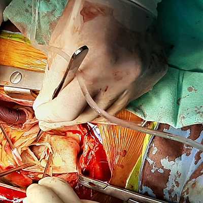 Timeline: Válvula Aórtica