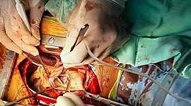 Timeline: Válvula Aórtica