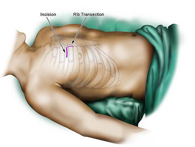 Reemplazo válvular aórtico minimamente invasivo
