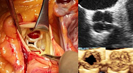 Timeline: EVOLUCION DEL TRATAMIENTO DE VALVULOPATIA AORTICA