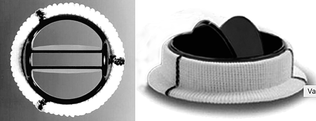 PROTESIS MECANICA BI-DISCO