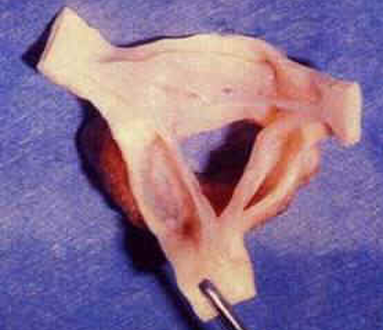 VALVULAS HOMOINJERTO