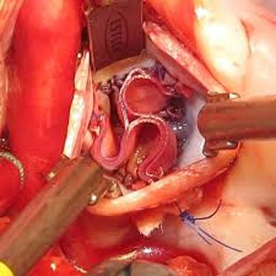 Timeline: Válvula Aórtica