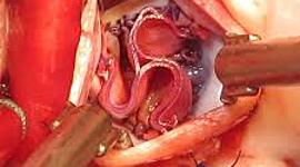 Timeline: Válvula Aórtica