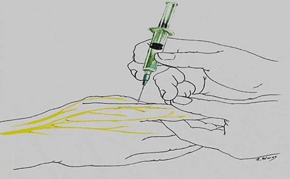 Desenvolupament de l'anestesia