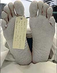 ACIDIFICACIÓN TISULAR