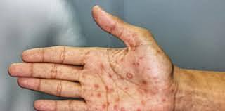 Descubren cura para la neurosifilis